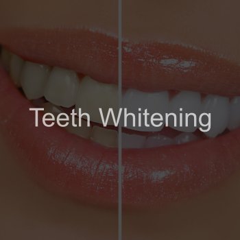 Teeth Whitening Near Me in Clifton, NJ