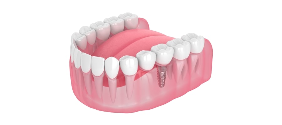 Dental Bridge Specialist Near Me in Clifton, NJ Dental Bridge Specialist Near Me in Clifton, NJ