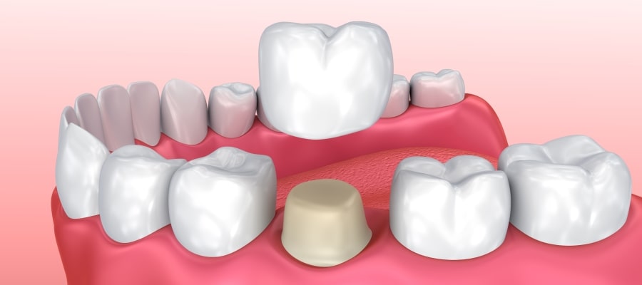 Dental Crown Specialist Near Me in Clifton, NJ Dental Crown Specialist Near Me in Clifton, NJ