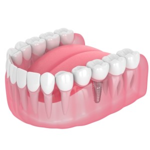 Dental Bridge Specialist Near Me in Clifton, NJ