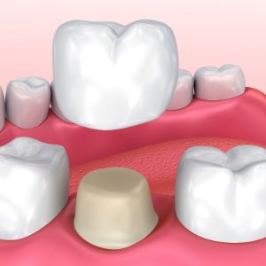 Dental Crown Specialist Near Me in Clifton, NJ