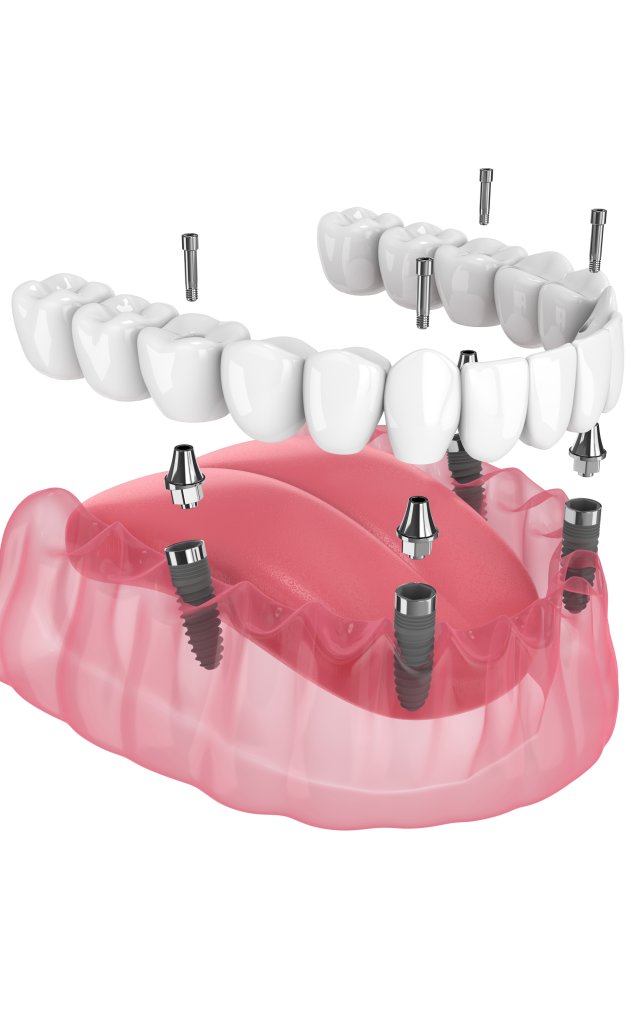 All-On-X Implants (Same Day) Near Me in Clifton, NJ
