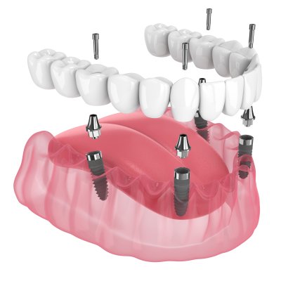 All-On-X Implants (Same Day) Near Me in Clifton, NJ
