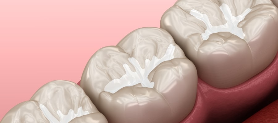 Dental Sealants Specialist Near Me in Clifton, NJ Dental Sealants Specialist Near Me in Clifton, NJ