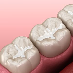 Dental Sealants Near Me in Clifton, NJ