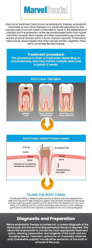 A root canal is a dental procedure that treats infections in the tooth pulp, the innermost layer of your tooth. Dr. Anna Gazu, DMD at Marvel Dental today to get comprehensive and specialized care. For more information, contact us today or book an appointment online. We are conveniently located at 1113 Main Avenue, Suite A, Clifton, NJ 07011. We serve patients from Clifton NJ, Passaic NJ, Woodland Park NJ, Nutley NJ, Garfield NJ, Fairfield NJ, and BEYOND! A root canal is a dental procedure that treats infections in the tooth pulp, the innermost layer of your tooth. Dr. Anna Gazu, DMD at Marvel Dental today to get comprehensive and specialized care. For more information, contact us today or book an appointment online. We are conveniently located at 1113 Main Avenue, Suite A, Clifton, NJ 07011. We serve patients from Clifton NJ, Passaic NJ, Woodland Park NJ, Nutley NJ, Garfield NJ, Fairfield NJ, and BEYOND!