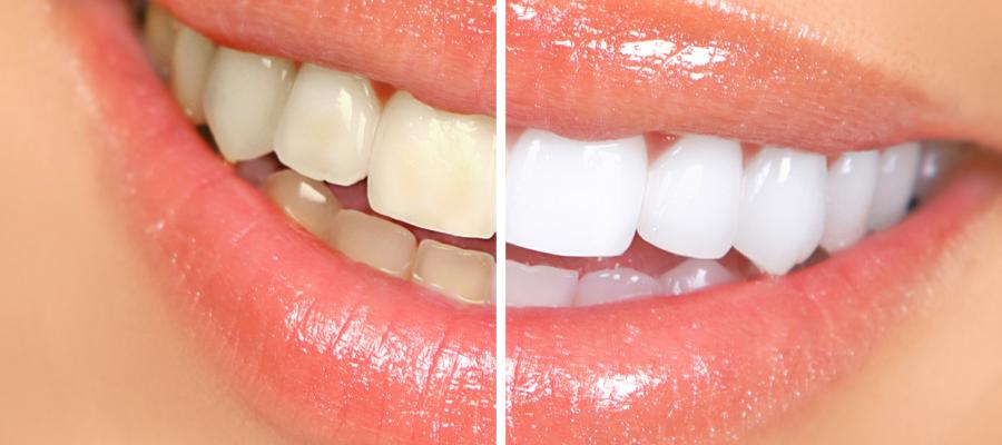 Teeth Whitening Specialist Near Me in Clifton, NJ Teeth Whitening Specialist Near Me in Clifton, NJ