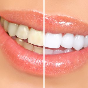 Teeth Whitening Services Near Me in Clifton, NJ
