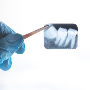 Dental X-Rays Specialist Near Me in Clifton, NJ Dental X-Rays Specialist Near Me in Clifton, NJ