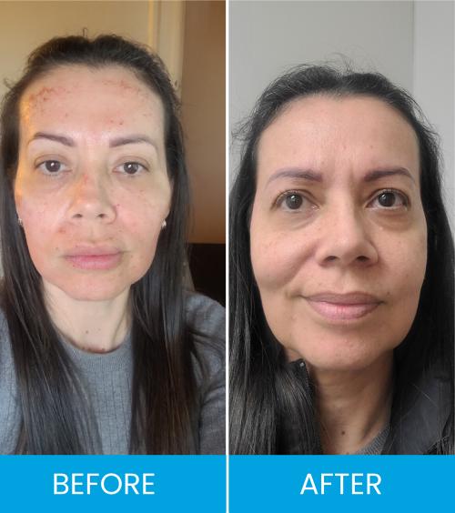 Bio Fillers Treatment Before & After Near Me in Clifton NJ Bio Fillers Treatment Before & After Near Me in Clifton NJ