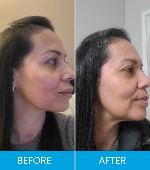 Bio Fillers Treatment Before & After Near Me in Clifton NJ Bio Fillers Treatment Before & After Near Me in Clifton NJ