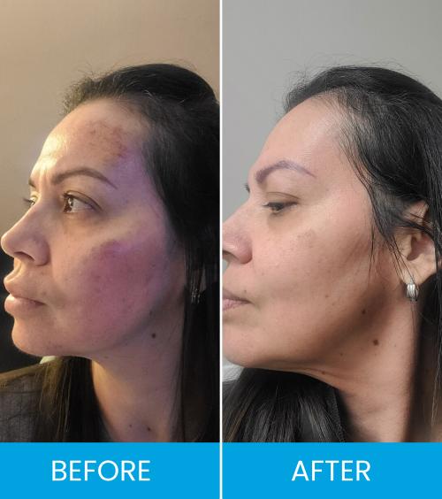Bio Fillers Treatment Before & After Near Me in Clifton NJ Bio Fillers Treatment Before & After Near Me in Clifton NJ
